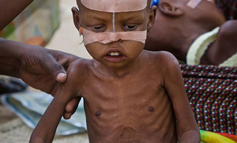 Suy dinh dưỡng - Hình ảnh minh họa